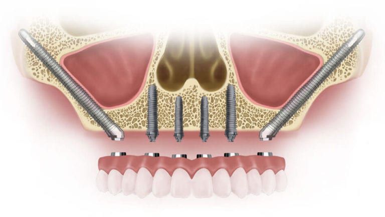 Implant dentar Zigomatic
